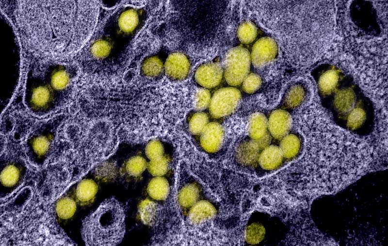 TEM of SARS-CoV-2 virus particles